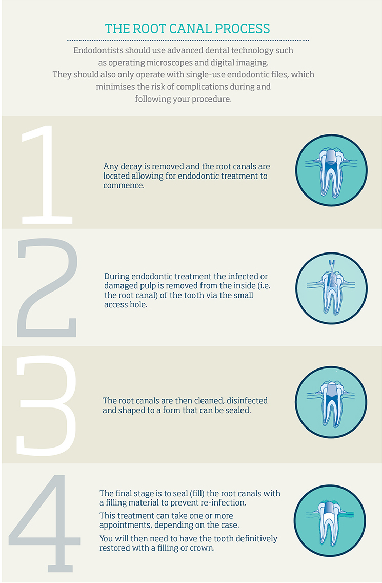 The Root Canal Process