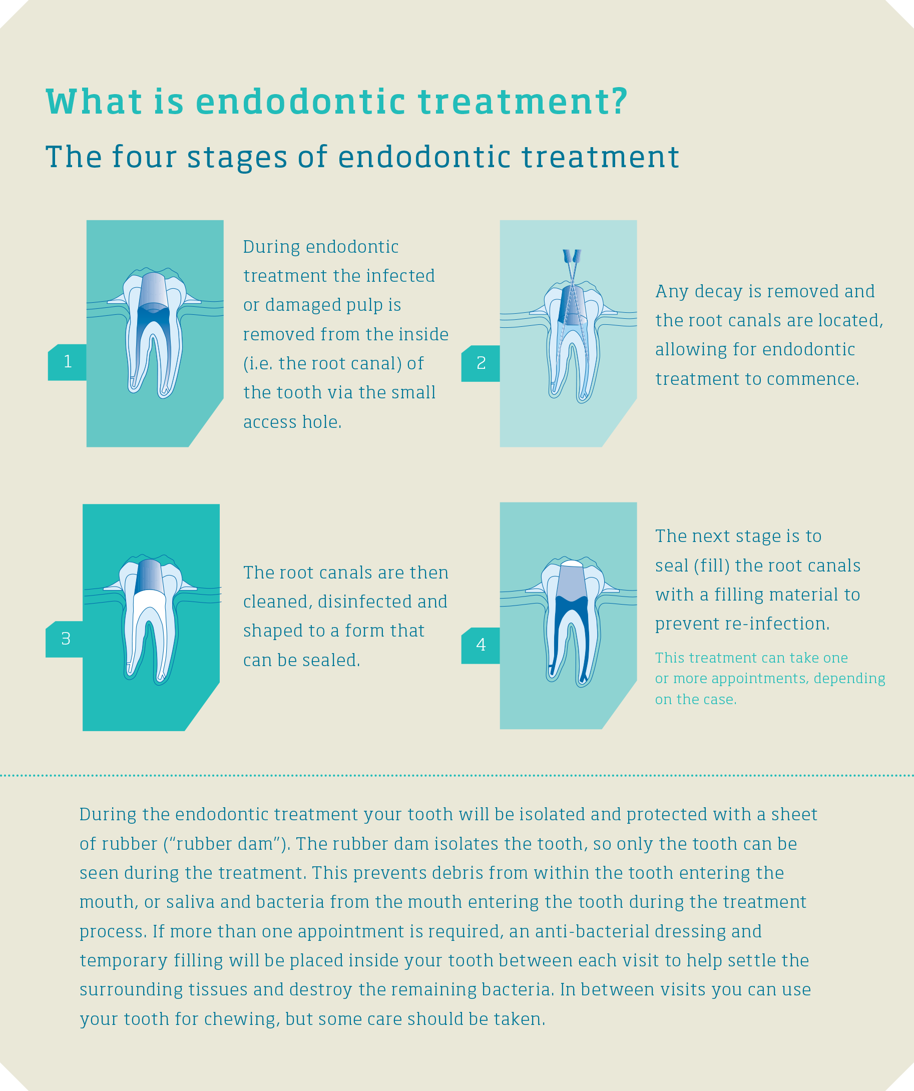 The four stages of endodontic treatment